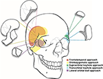 Frontiers | Cranio-Orbital and Orbitocranial Approaches to Orbital and ...