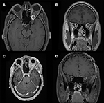 Frontiers | Cranio-Orbital and Orbitocranial Approaches to Orbital and ...