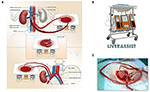 Frontiers | The First Case Of Ischemia-Free Kidney Transplantation In ...