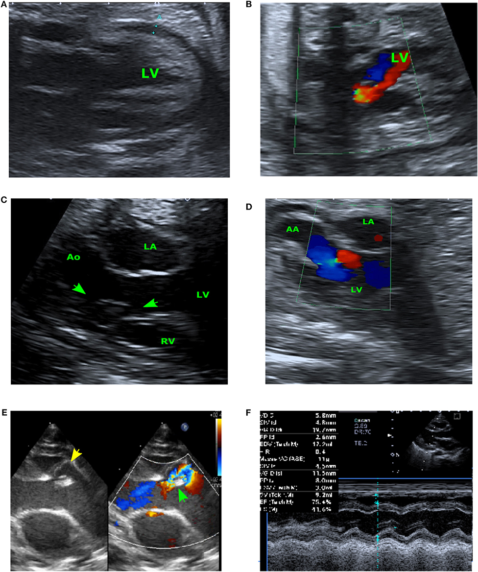 Frontiers Prenatal Diagnosis Of Aorto Left Ventricular Tunnel With Dysplastic Bicuspid Aortic