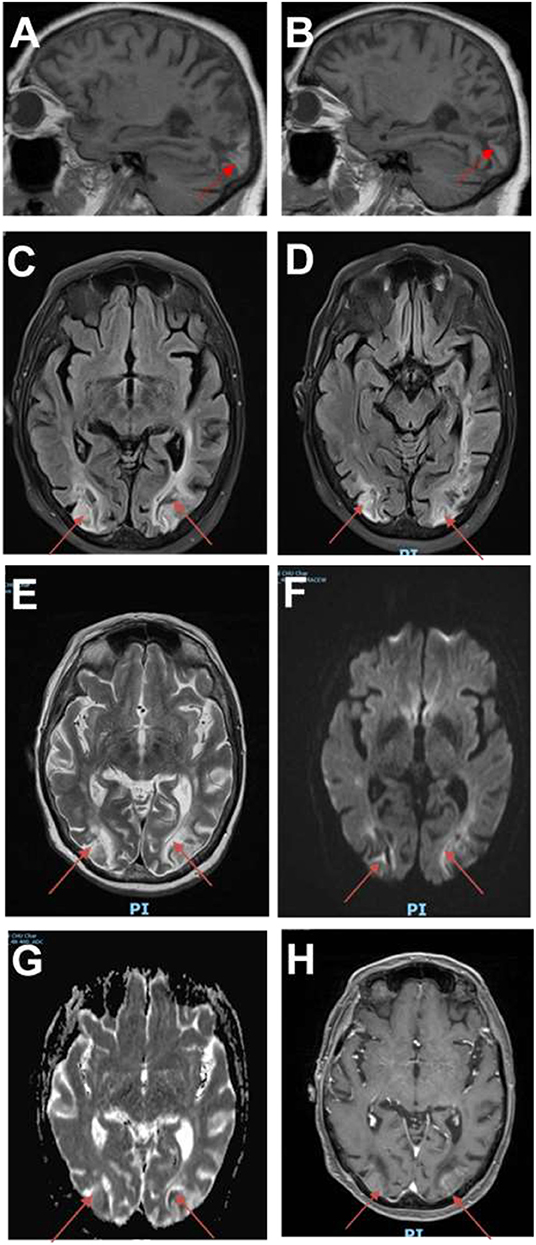 Frontiers | Delayed Posterior Reversible Leukoencephalopathy Syndrome ...