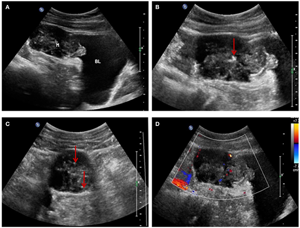 Frontiers | Imaging Features of Urachal Cancer: A Case Report