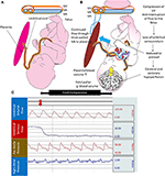 Frontiers | Placental Transfusion for Asphyxiated Infants | Pediatrics