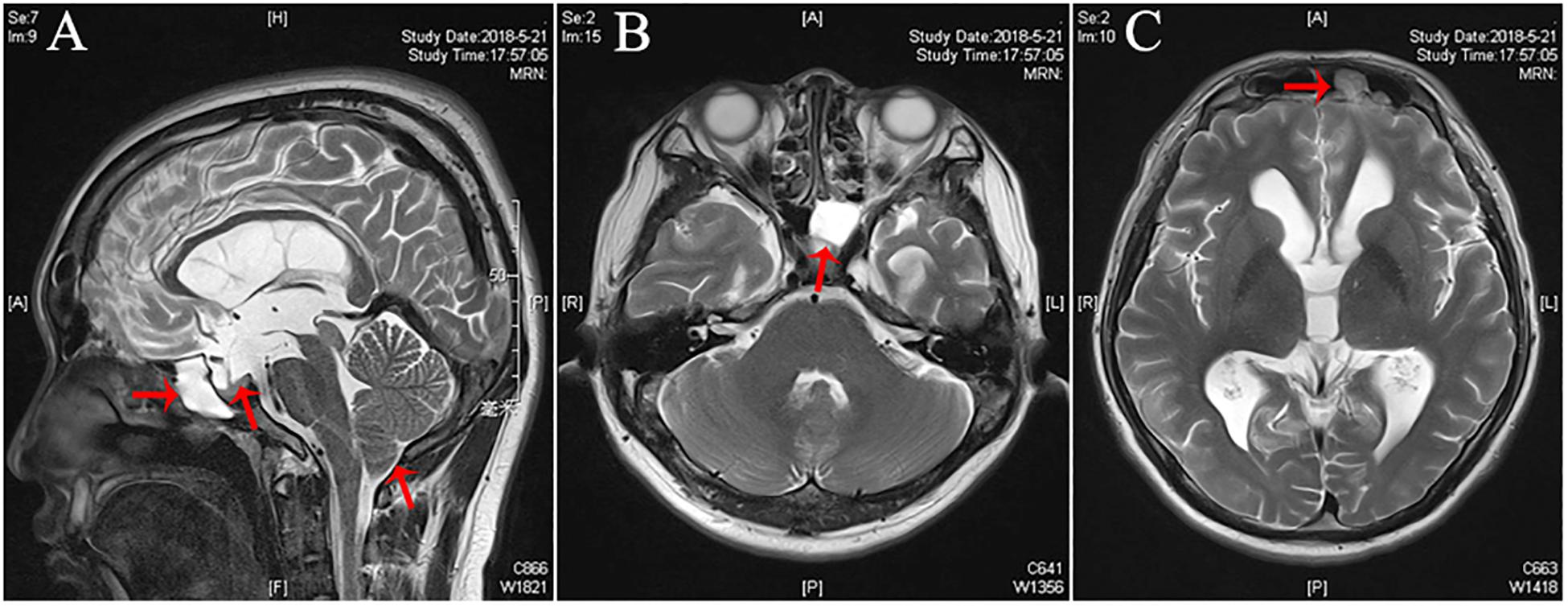 cerebrospinal fluid leak in brain after head trauma