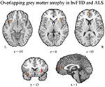 Frontiers | Comparison Of Gray Matter Atrophy In Behavioral Variant ...