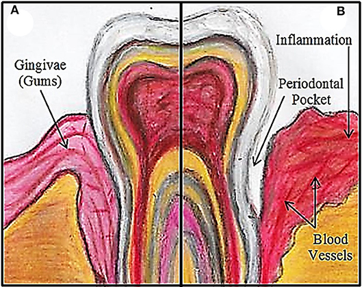 图1 - (A)一个健康的牙齿/口香糖。