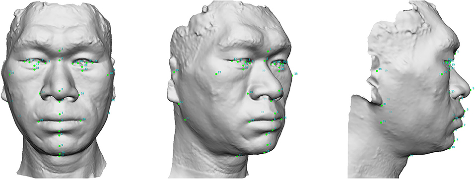 Frontiers Identifying Facial Features And Predicting Patients Of