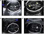 Frontiers | Automatic Measurements of Fetal Lateral Ventricles in 2D ...