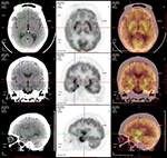 Frontiers | Clinical Characteristics of Anti-GABA-B Receptor ...