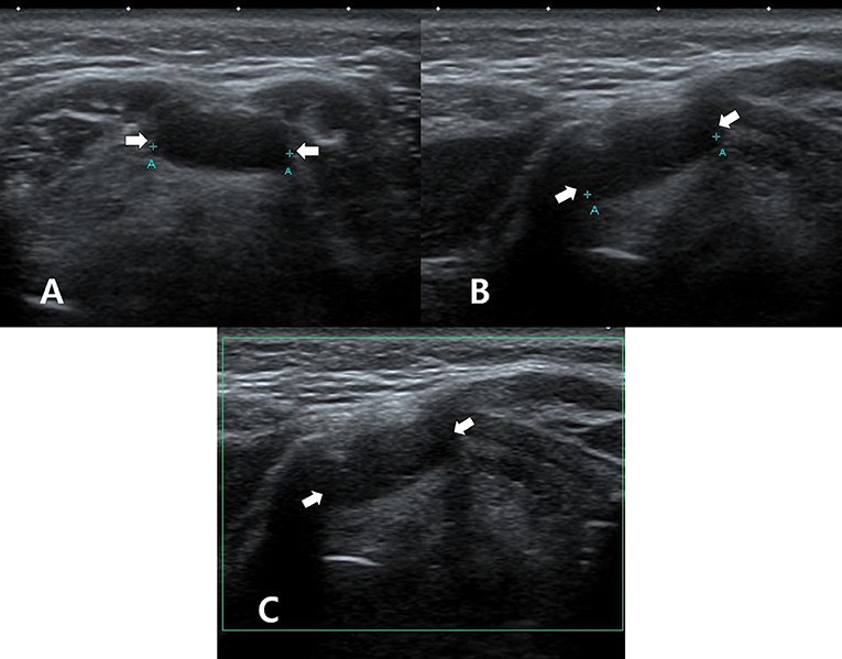 Thyroglossal Duct Cyst Ultrasound