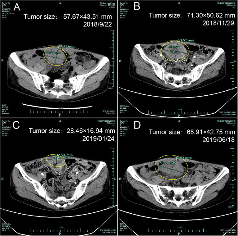 Frontiers | Early Onset Immune-Related Adverse Event To Identify Pseudo ...