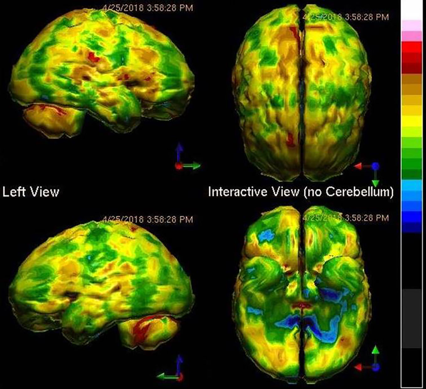 Frontiers  Functional Neuroimaging in Psychiatry—Aiding in