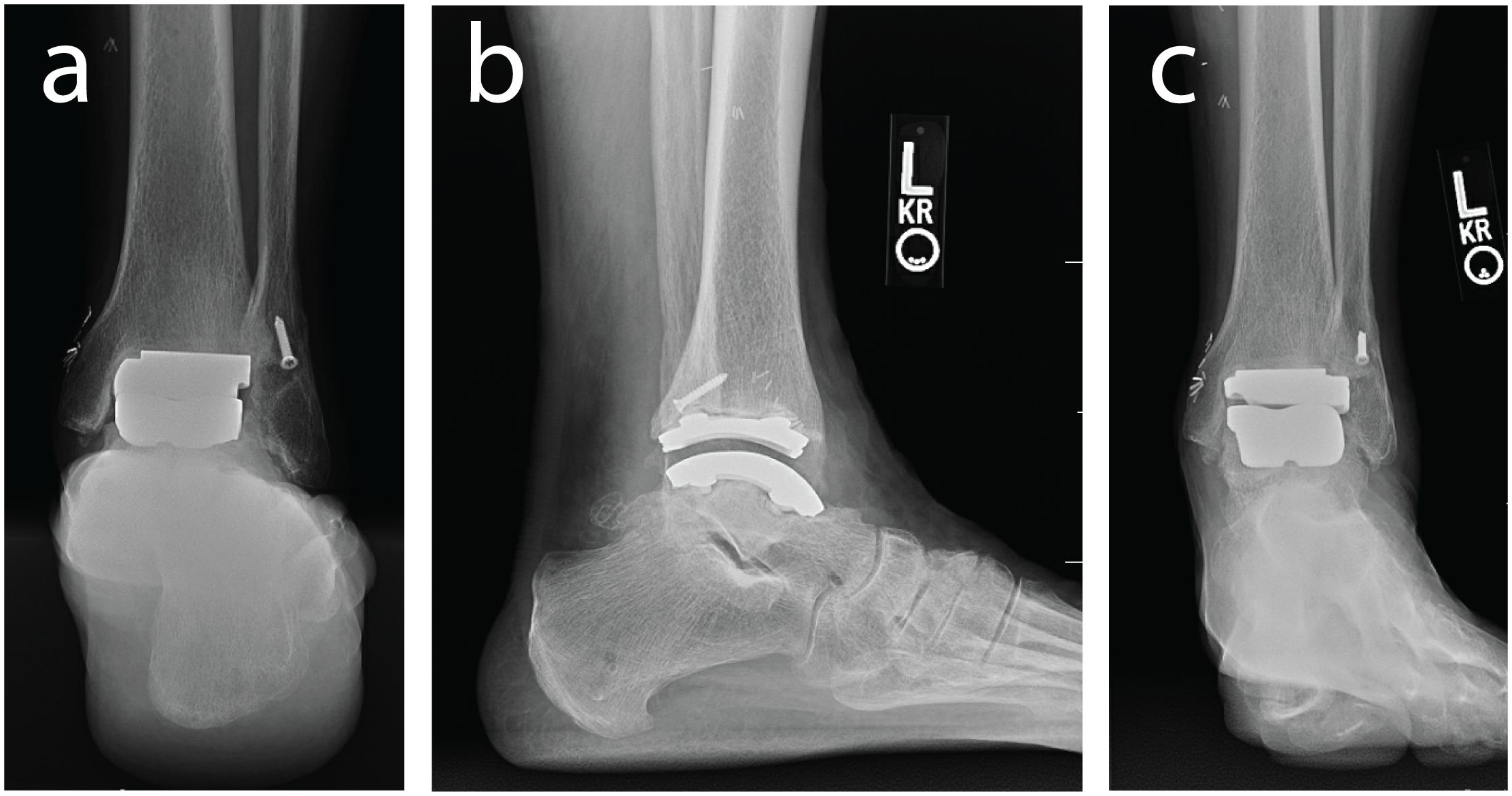 Distance mapping and volumetric assessment of the ankle and