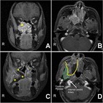 Frontiers | Modified Maxillary-Swing Approach for Resection of Primary ...