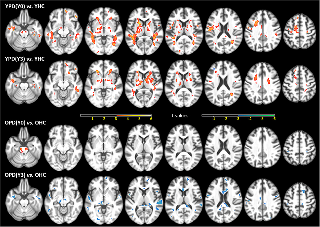 Frontiers | Diffusion Tensor Imaging in Parkinson's Disease