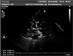 Frontiers | Kawasaki Disease in Infants in the First 3 Months of Age in ...