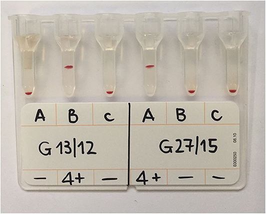 File:Blood typing by gel card method (column agglutination or MTS