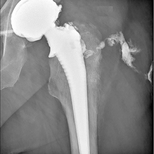 Frontiers  One-Stage Exchange Arthroplasty for Fistulizing Periprosthetic  Joint Infection of the Hip: An Effective Strategy