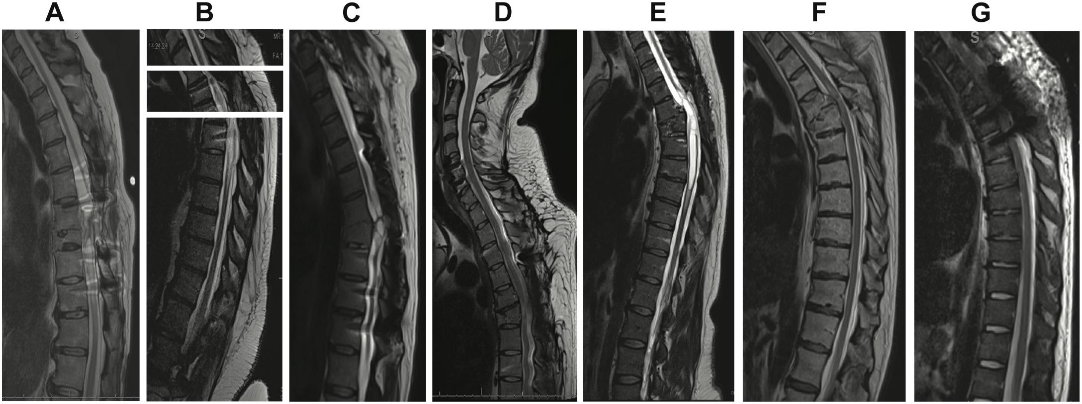 Frontiers Long Term Spinal Cord Stimulation After Chronic Complete
