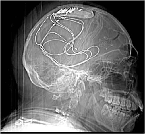 图3 -一个人头部的x光片显示了一个治疗癫痫发作的装置。