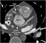 Frontiers | Symptomatic Coronary Anomalies and Ischemia in Teenagers ...