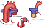 Frontiers | Reconstruction of the Neopulmonary Root After Coronary ...