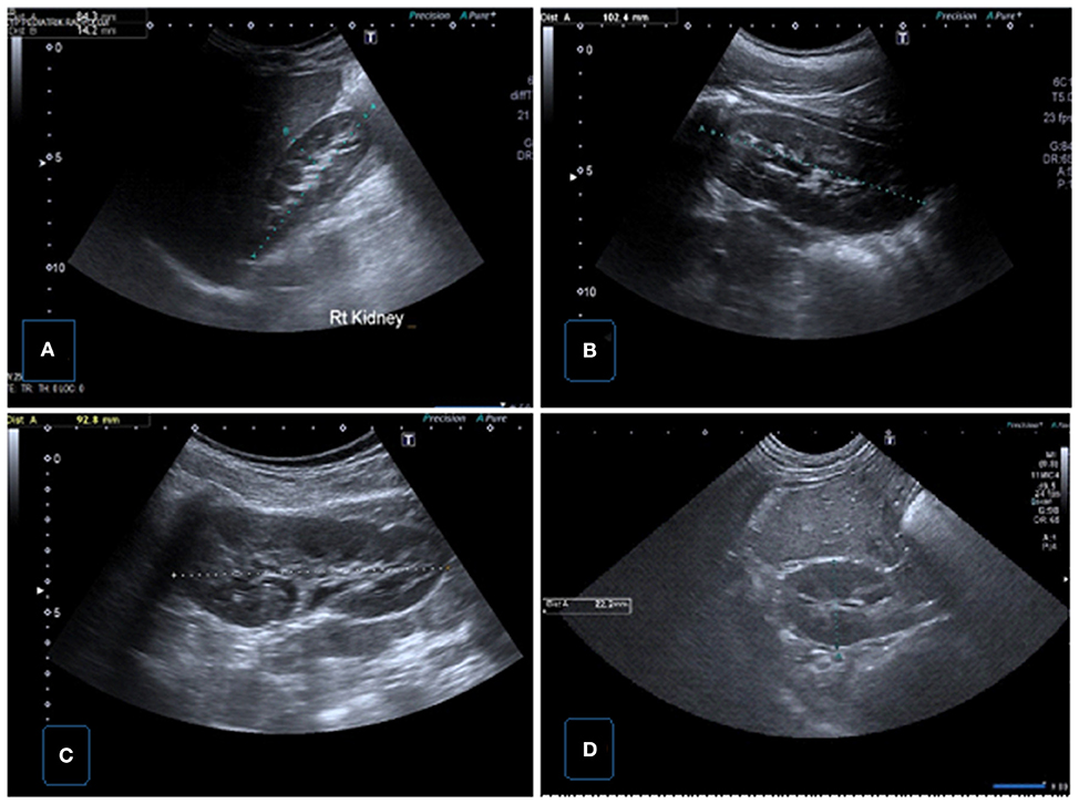 pyelonephritis ultrasound doppler