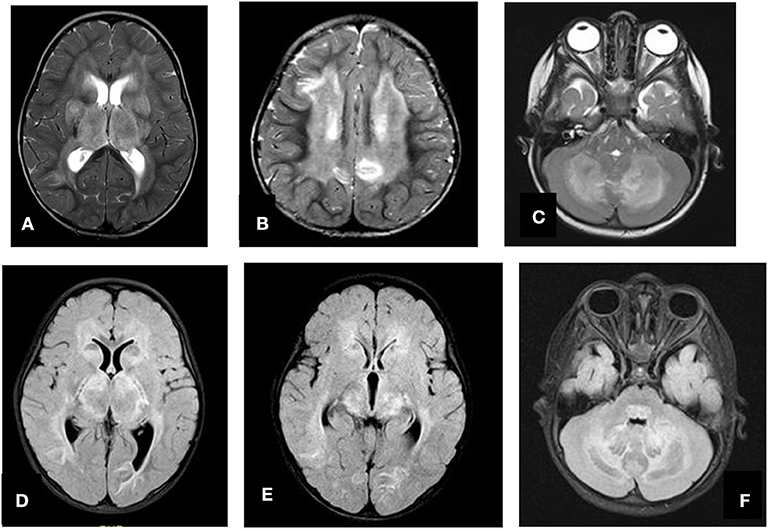 Frontiers | Acute Necrotizing Encephalopathy of Childhood: A ...