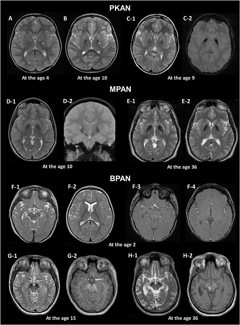 Frontiers | Brain MRI Pattern Recognition in Neurodegeneration With ...