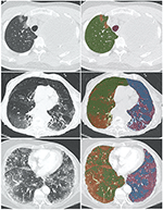 Frontiers | Quantitative CT Extent of Lung Damage in COVID-19 Pneumonia ...