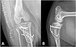 Frontiers | Case Report: Trochlear Wedge Sulcoplasty, Tibial Tuberosity ...