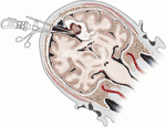 Frontiers | Surgical Management of Brain Metastases in the Perirolandic ...