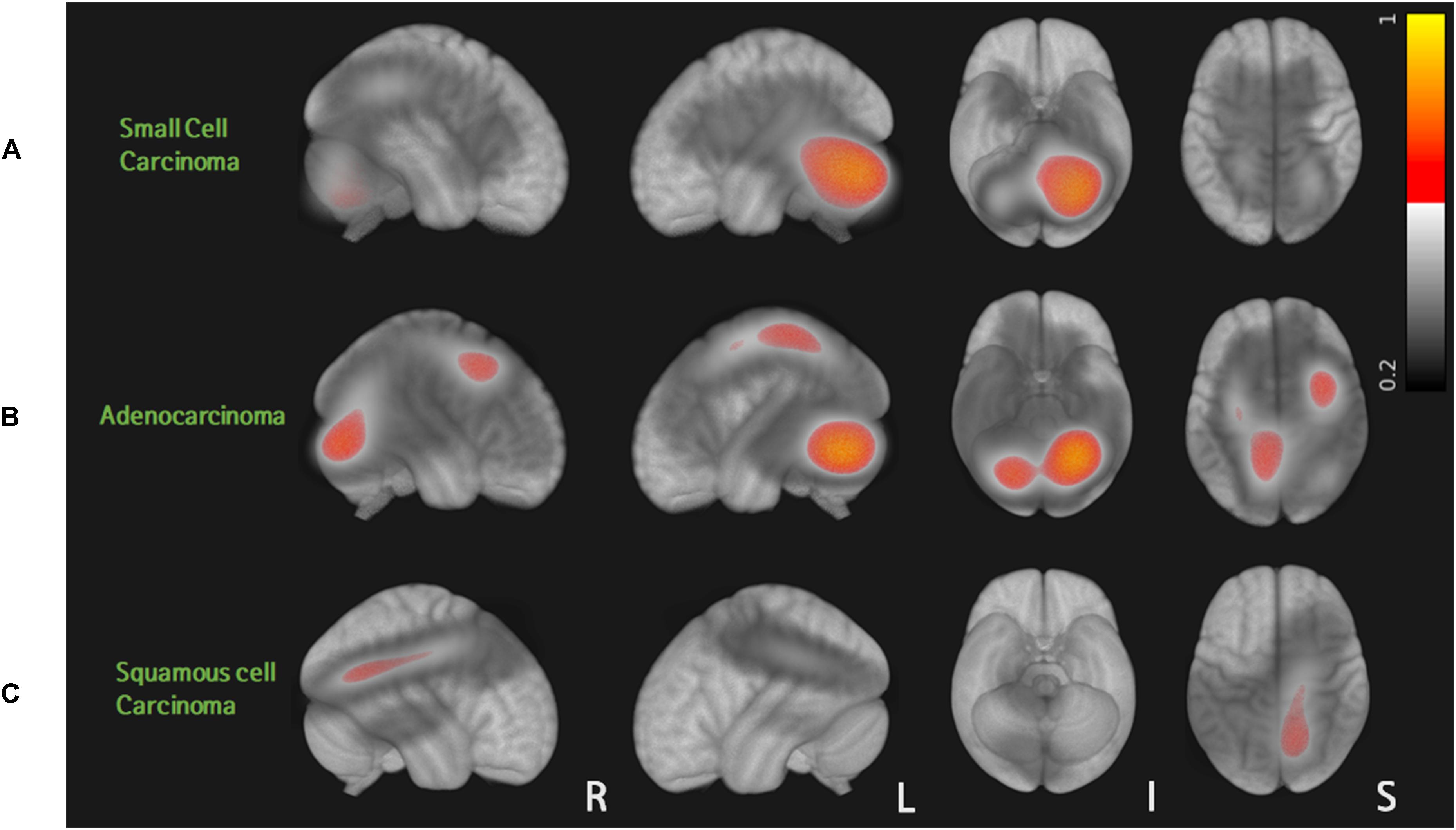 Frontiers Brain Metastases From Lung Adenocarcinoma May