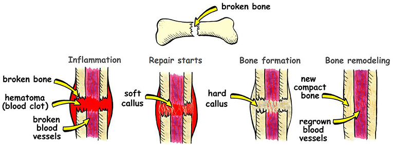 Figure 3 - Bone healing happens in four steps.