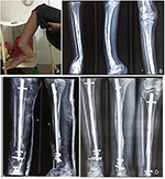 Frontiers | Response to Zoledronic Acid Infusion in Children With ...