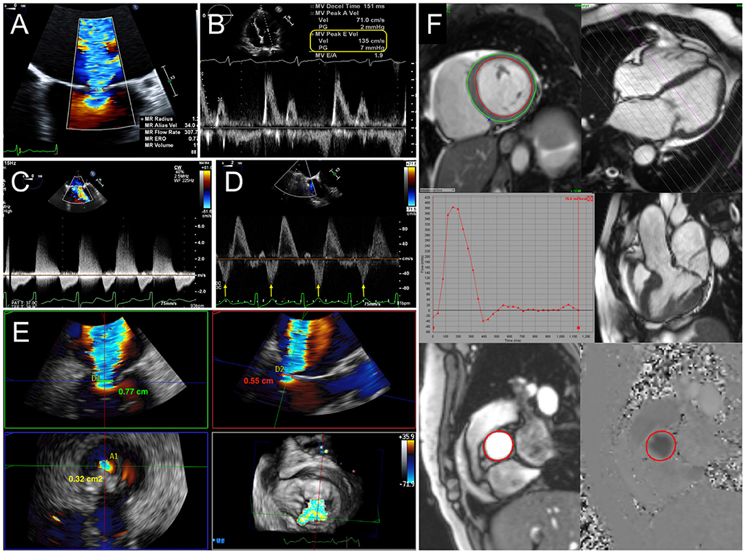 Frontiers | Multimodality Cardiac Imaging for Procedural Planning and  Guidance of Transcatheter Mitral Valve Replacement and Mitral Paravalvular  Leak Closure