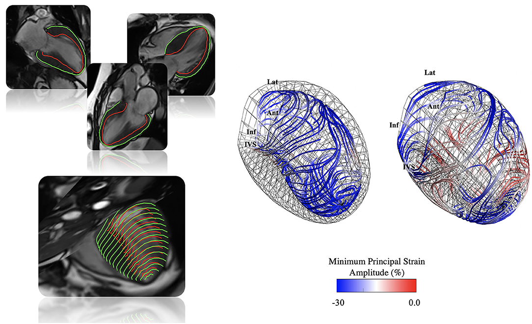 Myocardial Deformation Imaging