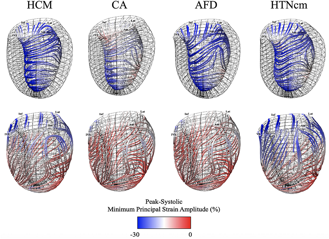 Apical Sparing of Longitudinal Strain, Left Ventricular Rotational  Abnormalities, and Short-Axis Dysfunctionin Primary Hyperoxaluria Type 1