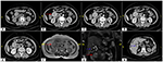 Frontiers | Case Report: Totally Laparoscopic Resection of ...