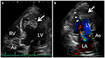 Frontiers | Late-Stage Löffler's Endocarditis Mimicking Cardiac Tumor ...