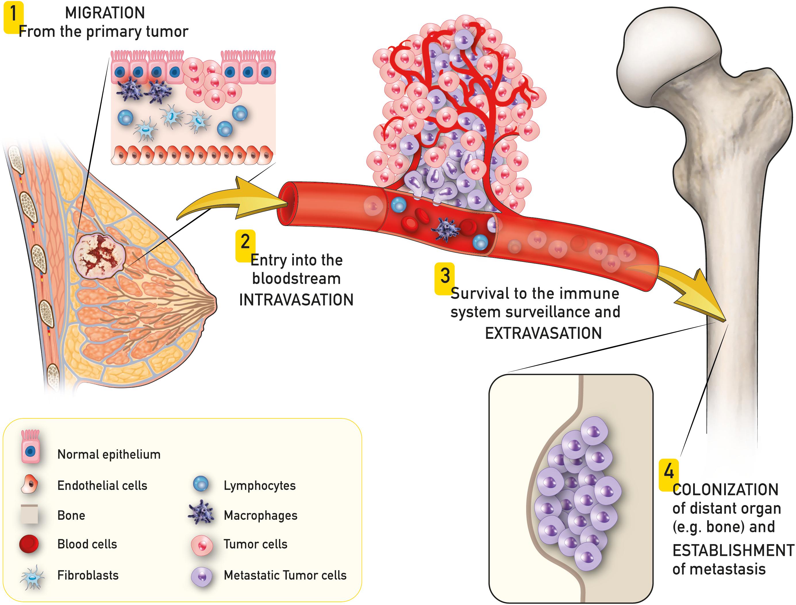 Frontiers Innovative Options For Bone Metastasis Treatment An 