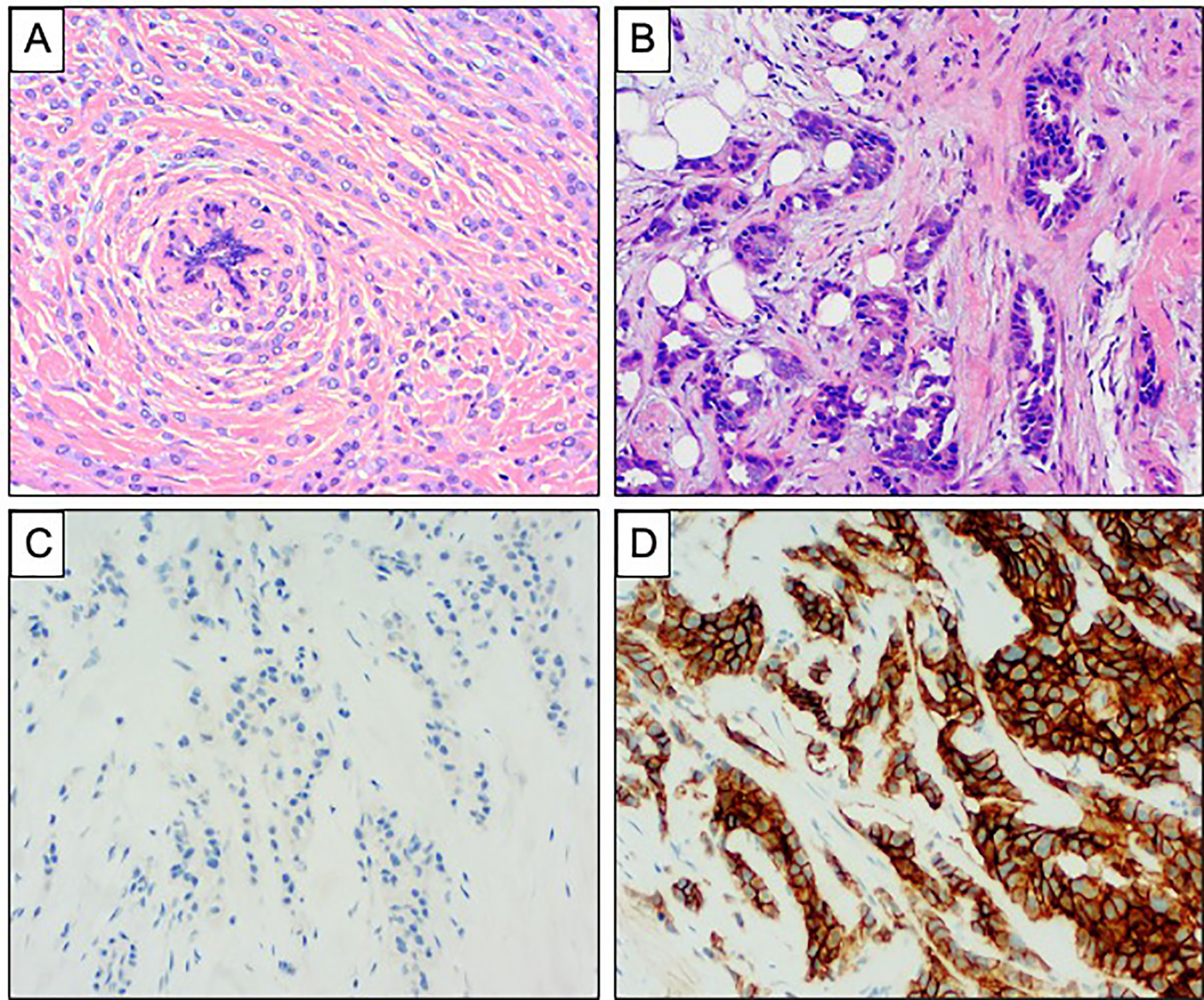 Frontiers  Lobular Breast Cancer: A Review