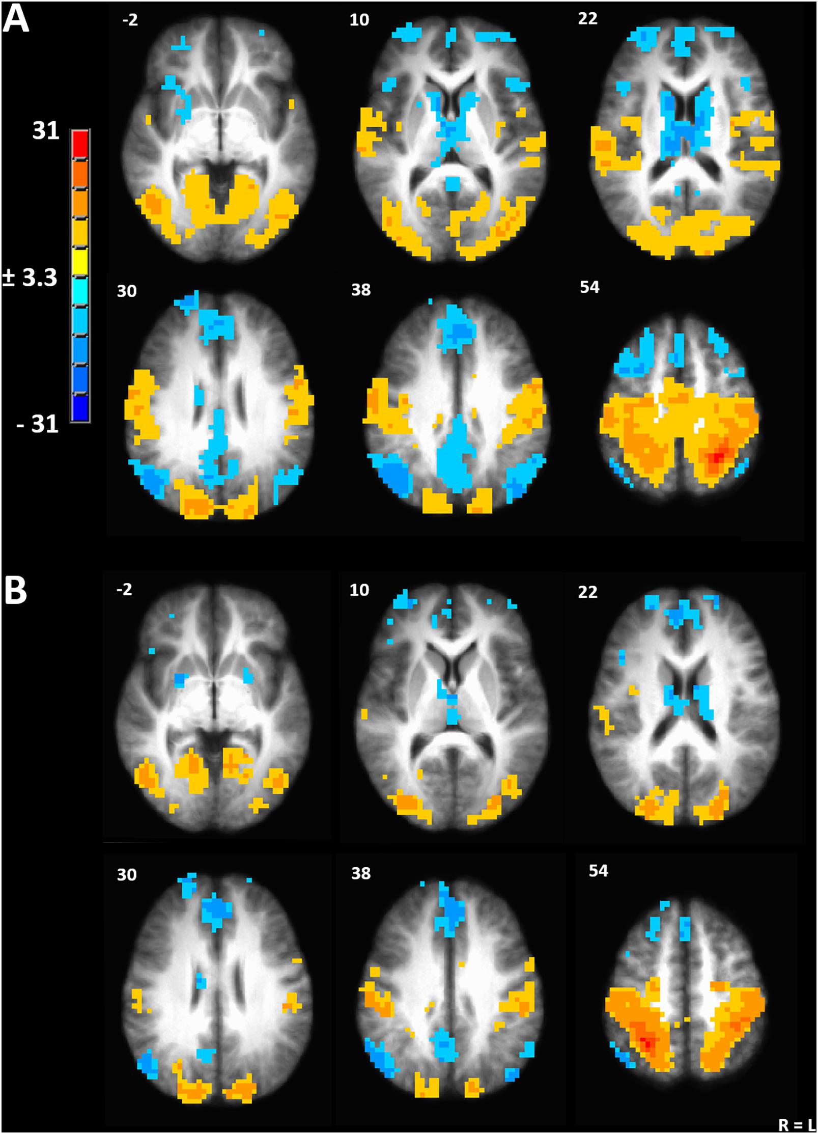 Frontiers  Menstrual Cycle Variations in Gray Matter Volume, White Matter  Volume and Functional Connectivity: Critical Impact on Parietal Lobe