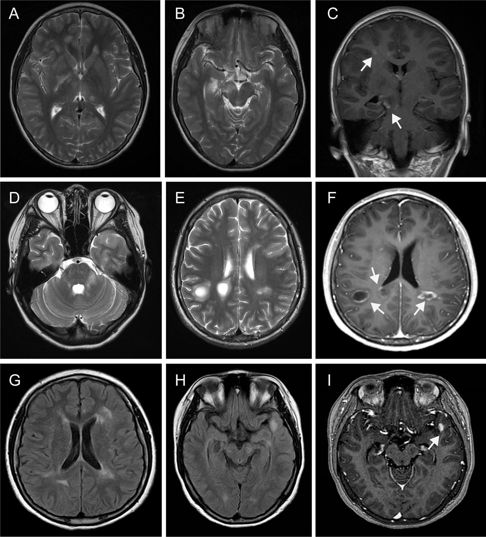 Frontiers | Case Report: Overlapping Multiple Sclerosis With Anti-N ...