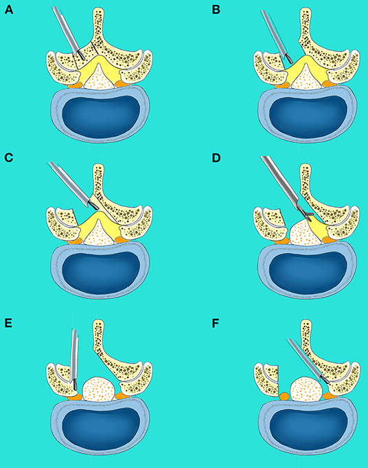 Frontiers | Comparison of Clinical Outcomes Following Lumbar Endoscopic ...