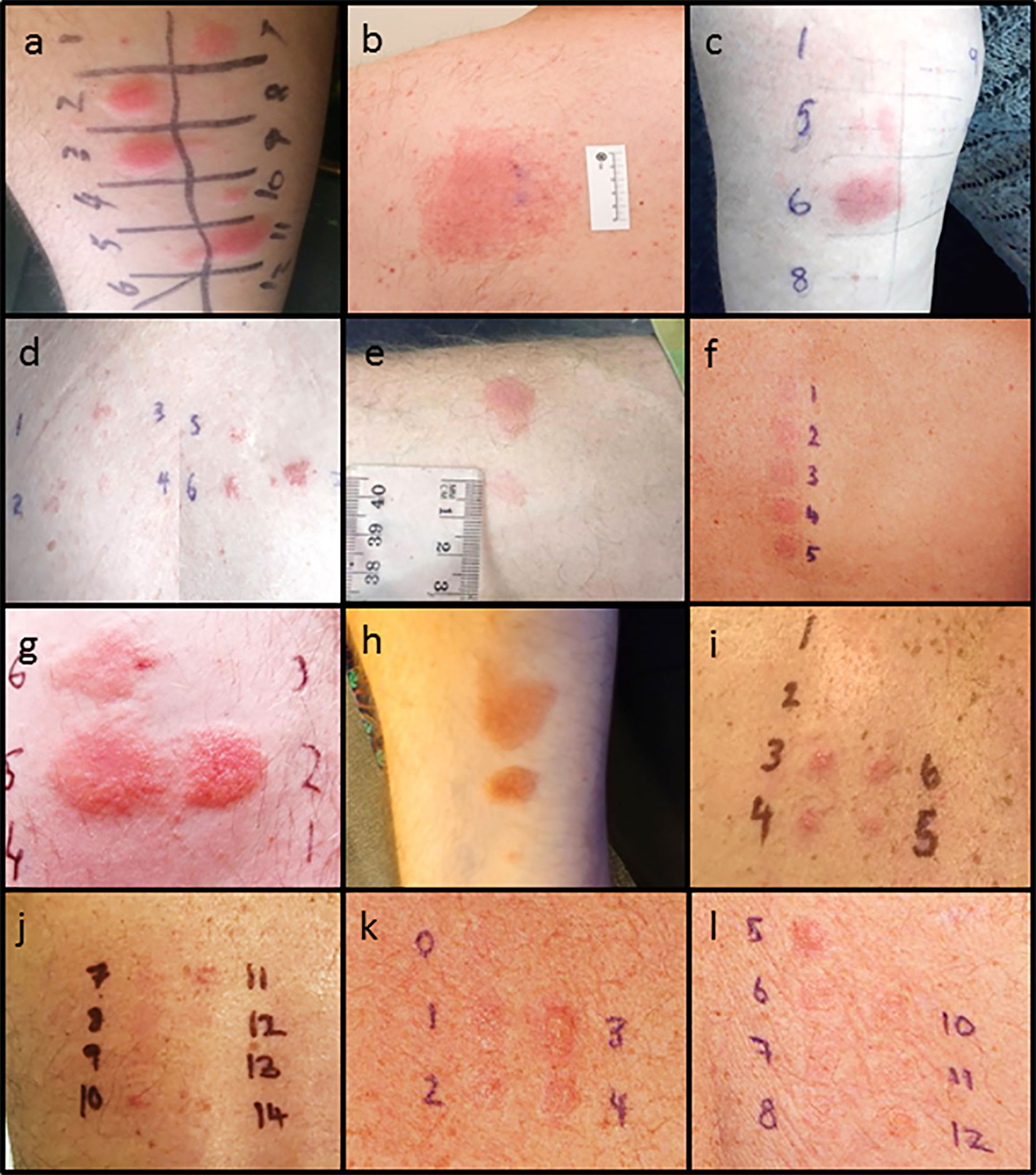 Amoxicillin Rash Adult