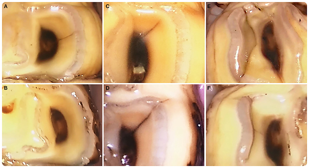 Figure 5 from Longitudinal tooth fractures: findings that