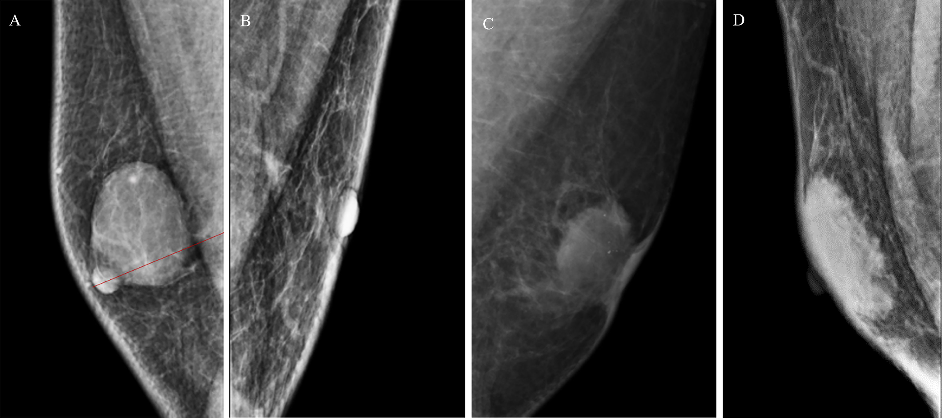 Mammography: Masses - Radiology