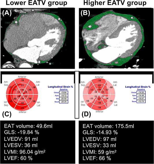 Frontiers  Deleterious Effects of Epicardial Adipose Tissue Volume on Global  Longitudinal Strain in Patients With Preserved Left Ventricular Ejection  Fraction