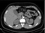 Frontiers | Case Report: Pheochromocytoma and Synchronous Neuroblastoma ...